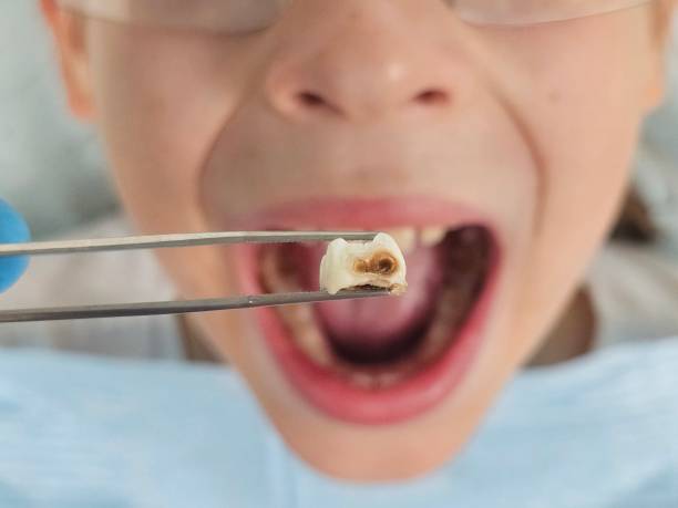 Best Emergency Root Canal Treatment in Blakely, GA